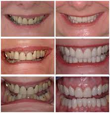 COST OF TEETH WHITENING IN BANGALORE. TEETH WHITENING COST IN BANGALORE. TEETH WHITENING BANGALORE. TEETH WHITENING COST. TEETH WHITENING COST BANGALORE. TEETH WHITENING COST BANGALORE. TEETH WHITENING BANGALORE COST