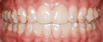 cleaned stained teeth, dental stain remover, teeth stain removal dentist, tooth stain removal, tooth stain removal in bangalore