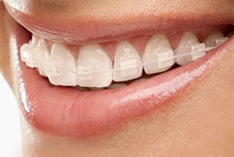 How to prevent Discoloration of Ceramic Braces 1