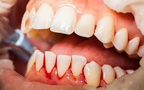 teeth scaling in bangalore, teeth scaling cost in bangalore, teeth cleaning cost in bangalore, teeth scaling cost, deep cleaning in bangalore, deep cleaning