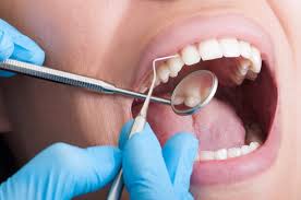 teeth scaling in bangalore, teeth scaling cost in bangalore, teeth cleaning cost in bangalore, teeth scaling cost, deep cleaning in bangalore, deep cleaning