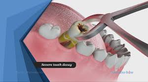 RCT IN BANGALORE, ROOT CANAL TREATMENT COST IN BANGALORE, ROOT CANAL COST IN BANGALORE, ROOT CANAL TREATMENT IN BANGALORE, COST OF ROOT CANAL TREATMENT IN BANGALORE