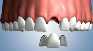  TOOTH REMOVAL IN BANGALORE. TOOTH EXTRACTION COST IN BANGALORE. WISDOM TEETH REMOVAL COST IN BANGALORE. TEETH REMOVAL COST IN BANGALORE. PAINLESS TOOTH EXTRACTION IN BANGALORE. 