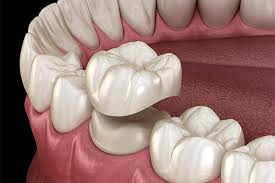 TEETH CAP PRICE, CROWN COST IN BANGALORE, TOOTH CAP PRICE, ROOT CANAL CAP COST, DENTAL CAP PRICE.