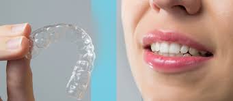 invisible braces in bangalore, cost of invisible braces in bangalore, invisible braces cost in bangalore, invisible braces cost bangalore