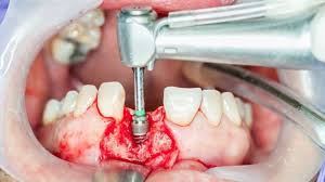 ROOT CANAL IN BANGALORE, ROOT CANAL TREATMENT IN BANGALORE, root canal specialist in bangalore, best root canal treatment in bangalore, root canal treatment bangalore,