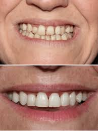 COST OF TEETH WHITENING IN BANGALORE. TEETH WHITENING COST IN BANGALORE. TEETH WHITENING BANGALORE. TEETH WHITENING COST. TEETH WHITENING COST BANGALORE. TEETH WHITENING COST BANGALORE. TEETH WHITENING BANGALORE COST
