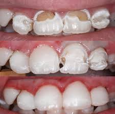 Teeth braces price in Bangalore , Best dentist for braces in Bangalore , Bite blocks braces , Turbo bites for braces , Braces cost near me
