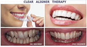 BEST INVISIBLE RETAINERS, BEST INVISIBLE ALIGNERS FOR TEETH, BEST INVISIBLE ALIGNERS, INVISIBLE ALIGNERS NEAR ME, BEST INVISIBLE TEETH ALIGNERS,